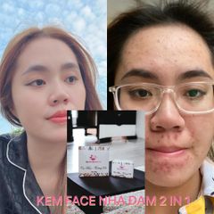 Kem Face Nha Đam 2 in 1 Ngừa Mụn Giảm Thâm - Sản Phẩm Chăm Sóc Da Mặt Tự Nhiên Hỗ Trợ Điều Trị Mụn Từ Nhà