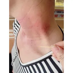 Kem Tẩy Nốt Ruồi Độc Quyền - Giải Pháp Xóa Mụn Cóc, Mụn Thịt & Sẹo Lồi An Toàn Tại Nhà, Da Mịn Màng, Không Để Lại Vết Thâm