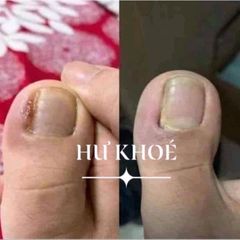 Combo 3 Chai Serum Chăm Sóc Móng Tay Chân - Trị Nấm Móng, Hư Khoé, Dưỡng Dài Móng Khỏe, 4ml