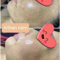 Bộ sản phẩm giảm thâm nám AiThan - Kem dưỡng trắng da, làm sáng và làm mờ vết nám hiệu quả, giá trị cho làn da khỏe đẹp.