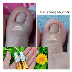 Serum Phục Hồi Móng - Combo 2 Chai 4ml Trị Nấm Móng, Hư Khoé, Bọng Móng - Giải Pháp Chăm Sóc Móng Chân Tay Hiệu Quả