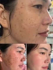 Kem Tẩy Nốt Ruồi Tàn Nhang Tại Nhà - An Toàn, Hiệu Quả Cho Mụn Thịt, Mụn Cóc, Đồi Mồi - Sản Phẩm Mỹ Phẩm Đáng Tin Cậy