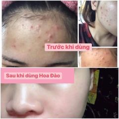 Kem Khử Mụn Hoa Đào - Thảo Dược Tự Nhiên Ngăn Ngừa Mụn, Làm Mờ Vết Thâm, Dưỡng Trắng Da cho Nam và Nữ - Chăm Sóc Da Hiệu Quả