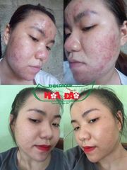 Kem Khử Mụn Hoa Đào - Thảo Dược Tự Nhiên Ngăn Ngừa Mụn, Làm Mờ Vết Thâm, Dưỡng Trắng Da cho Nam và Nữ - Chăm Sóc Da Hiệu Quả