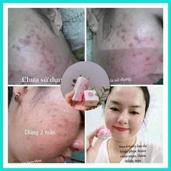 Kem Khử Mụn Hoa Đào - Thảo Dược Tự Nhiên Ngăn Ngừa Mụn, Làm Mờ Vết Thâm, Dưỡng Trắng Da cho Nam và Nữ - Chăm Sóc Da Hiệu Quả