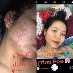 Kem Khử Mụn Hoa Đào - Thảo Dược Tự Nhiên Ngăn Ngừa Mụn, Làm Mờ Vết Thâm, Dưỡng Trắng Da cho Nam và Nữ - Chăm Sóc Da Hiệu Quả