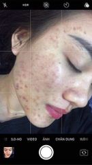 Serum Trị Mụn Handmade 10ml - Giảm Mụn Đầu Đen, Mụn Ẩn, Xóa Thâm, Sáng Da, An Toàn Cho Da Nhạy Cảm