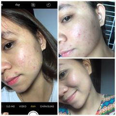 Kem Mụn Hoa Đào - Giải Pháp An Toàn Cho Da Sạch Mụn, Dưỡng Trắng Tự Nhiên, Phục Hồi Da Khô, Hiệu Quả Chỉ Sau 2 Tuần Sử Dụng