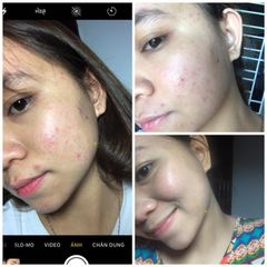 Kem Mụn Hoa Đào - Giải Pháp An Toàn Cho Da Sạch Mụn, Dưỡng Trắng Tự Nhiên, Phục Hồi Da Khô, Hiệu Quả Chỉ Sau 2 Tuần Sử Dụng