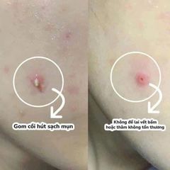 Miếng dán mụn thần thánh CARE PLUS - Bán chạy Olive Young, Gel lột mụn, 102 miếng, Hút mụn nhanh, Chống nước, Chất liệu Hydrocolloid cao cấp