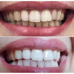 (HÀNG CHÍNH HÃNG MỸ) LỐC 5 CÂY KEM ĐÁNH RĂNG CREST PRO HEALTH - WHITENING INTENSITIVE MỚI LIMITED MỸ 167g