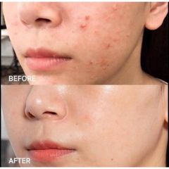 Tinh Chất Giảm Mụn SVR Sebiaclear Flash 30ml - Hỗ Trợ Làm Dịu Da, Mờ Thâm Với 15% Azelaic Acid và Salicylic Acid Cho Da Nhạy Cảm