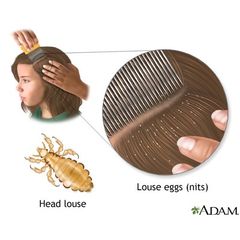 Tinh Chất Diệt Chấy Puressentiel - Giải Pháp Hoàn Toàn Cho Mái Tóc Khỏe Mạnh, An Toàn, Hiệu Quả Chỉ Trong 10 Phút - 100ml