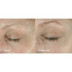 Kem Dưỡng Mắt Isdinceutics Hyaluronic Eyes 15g - Gel Cấp Ẩm Giảm Quầng Thâm, Làm Sáng Da Mắt, Hàng Chính Hãng Từ Tây Ban Nha