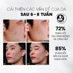 Tẩy Tế Bào Chết Kiểm Soát Dầu Mụn MD CARE AntiAc Exfo - Giảm Viêm, Sạch Da Hiệu Quả, Dành Cho Da Dầu Mụn