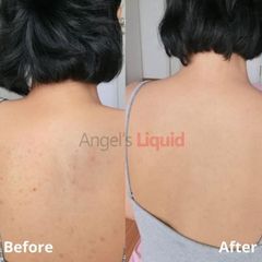 Xịt Giảm Mụn Lưng Angel's Liquid Glutathione 150ml - Giúp Làm Mờ Thâm và Ngăn Ngừa Mụn Hiệu Quả Cho Da êm Ái