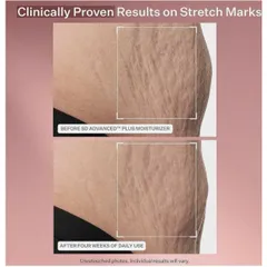 Set Kem Dưỡng Ẩm StriVectin SD Advanced Plus - Giảm Nếp Nhăn và Rạn Da (47ml x 2 tuýp) Mỹ - Làm Sáng Da, Duy Trì Collagen