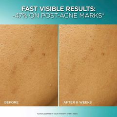 Tẩy da chết hoá học L’oreal Bright Reveal Peeling Exfoliant 25% [AHA + BHA + PHA] mờ thâm sạm