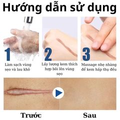 Kem Xóa Sẹo Hiệu Quả – Làm Mờ Sẹo Cũ, Sẹo Phẫu Thuật, Sẹo Mụn Trứng Cá & Vết Rạn Da, Dưỡng Da Mịn Màng, Mỹ Phẩm Hoa Kỳ
