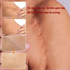 Kem Xóa Sẹo EELHOE - Giải Pháp Hiệu Quả Xóa Sẹo Lâu Năm, Phẫu Thuật và Rạn Da Sau Mang Thai
