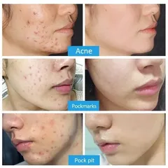 Gel Loại Bỏ Mụn - Kem Giảm Mụn Nhanh 25g, Hỗ Trợ Mờ Vết Thâm, Kiểm Soát Dầu, Phục Hồi Da, Sản Phẩm Chăm Sóc Da Chất Lượng