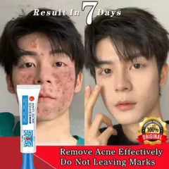 Gel Loại Bỏ Mụn - Kem Giảm Mụn Nhanh 25g, Hỗ Trợ Mờ Vết Thâm, Kiểm Soát Dầu, Phục Hồi Da, Sản Phẩm Chăm Sóc Da Chất Lượng