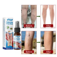 Xịt Bôi Hỗ Trợ Suy Giãn Tĩnh Mạch South Moon – Giảm Đau, Giúp Lưu Thông Mạch Máu, Phục Hồi Da, Chăm Sóc Sức Khỏe Tại Nhà