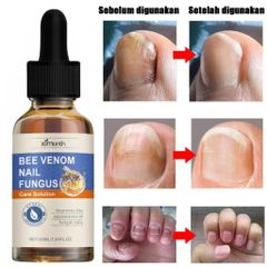 Tinh Chất Loại Bỏ Nấm Móng 50ML - Kem Phục Hồi Móng Tay, Chân Kháng Khuẩn, Chăm Sóc Móng Yếu, Hỗ Trợ Khôi Phục Sức Khỏe Móng