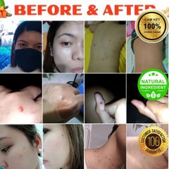 Bút Tẩy Nốt Ruồi & Xóa Mụn Thịt - Sản Phẩm Chăm Sóc Da Thiên Nhiên, Không Đau Rát, Hiệu Quả Nhanh Chóng