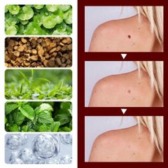 Bút Tẩy Nốt Ruồi & Xóa Mụn Thịt - Sản Phẩm Chăm Sóc Da Thiên Nhiên, Không Đau Rát, Hiệu Quả Nhanh Chóng