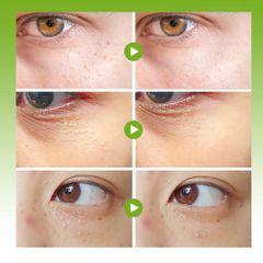 Kem Tẩy Mụn Thịt Quanh Mắt SUMIFUN - Giảm Thâm và Dưỡng Da Mắt với Vitamin E, Hỗ Trợ Làm Mịn Vùng Da Nhạy Cảm