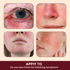 Kem Bôi Mũi Đỏ Rosacca - Giải Pháp Thảo Mộc 100% Cho Da Nhạy Cảm, Dị Ứng, Viêm Da Mặt, Hỗ Trợ Làm Dịu, Phục Hồi Da Tổn Thương