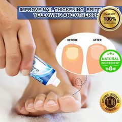Kem Bôi Nấm Móng Thối Móng SUMIFUN – Chiết Xuất Thiên Nhiên An Toàn, Hỗ Trợ Khắc Phục Móng Yếu, Nấm Móng, Thối Móng