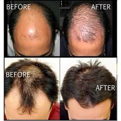 Dung Dịch Kích Tóc Rogaine 5% Minoxidil Cho Nam - Giải Pháp Hiệu Quả Cho Tình Trạng Rụng Tóc, Phục Hồi Mái Tóc Khỏe Đẹp