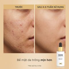 Serum ISDIN Isdinceutics Salicylic Renewal 30ml - Giảm mụn, Làm sáng da, Mờ thâm, Chăm sóc da dầu và hỗn hợp