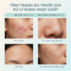 Serum La Roche-Posay Effaclar 30ml - Tinh Chất Giảm Mụn, Mờ Thâm, Thu Nhỏ Lỗ Chân Lông Cho Da Dầu Mụn, Mỹ Phẩm Pháp