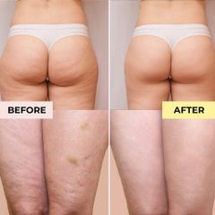 Kem Somatoline Giảm Sần Vỏ Cam và Tan Mỡ Đùi - Kem Chống Cellulite Thermoactive 250ml cho Da Mịn màng, Săn Chắc