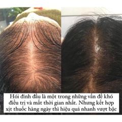 Xịt mọc tóc Minoxidil 5% BAILLEUL - Giảm rụng tóc, kích thích mọc tóc hiệu quả cho nam và nữ - Best Seller Pháp