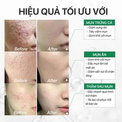 Tinh Chất Giảm Mụn Mờ Thâm SVR Sebiaclear Flash Ampoule 30ML - Dưỡng Da Nhạy Cảm, Giảm Mụn, Đỏ và Vết Thâm, Hiệu Quả Nhanh Chóng
