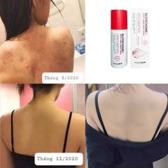 Xịt Giảm Mụn Lưng Angel's Liquid Glutathione + Centella 150ml - Làm Sáng Da, Mờ Thâm, Chăm Sóc Cơ Thể Tự Nhiên