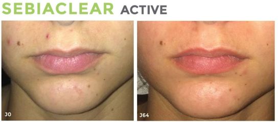Sữa Rửa Mặt SVR Sebiaclear Gel Moussant 200ml - Chống Mụn, Dịu Nhẹ Cho Da Nhạy Cảm, Gel Tạo Bọt Kháng Nước, Không Xà Phòng