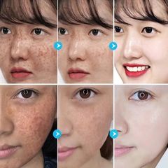 Kem Nám Tàn Nhang Trắng Da Mặt 30g - Giải Pháp Làm Sáng Da và Dưỡng Ẩm Hiệu Quả, Loại Bỏ Đốm Nám và Tàn Nhang