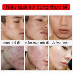 Gel Trị Mụn Nhanh - Hỗ Trợ Giảm Mụn Trong 3 Ngày, Kiểm Soát Dầu, Làm Mờ Vết Thâm Da - Sản Phẩm Cho Da Dầu, Da Dễ Nổi Mụn
