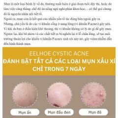 Gel Trị Mụn Nhanh - Hỗ Trợ Giảm Mụn Trong 3 Ngày, Kiểm Soát Dầu, Làm Mờ Vết Thâm Da - Sản Phẩm Cho Da Dầu, Da Dễ Nổi Mụn