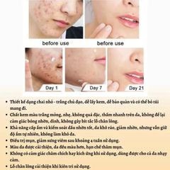 Gel Trị Mụn Nhanh - Hỗ Trợ Giảm Mụn Trong 3 Ngày, Kiểm Soát Dầu, Làm Mờ Vết Thâm Da - Sản Phẩm Cho Da Dầu, Da Dễ Nổi Mụn