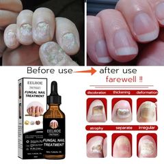 Serum Dưỡng Móng Eelhoe 30ml - Hỗ Trợ Loại Bỏ Nấm Móng, Cải Thiện Móng Hư Tổn, Dưỡng Chắc Khỏe Tự Nhiên