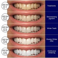 Miếng Dán Trắng Răng Hiệu Quả Nhanh - Phù Hợp Mọi Loại Răng, Không Gây Ê Buốt, Giúp Răng Trắng Sáng Nhanh Chóng Tại Nhà