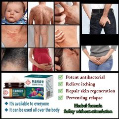 Kem chống ngứa kem kháng khuẩn chống dị ứng khỏi tận gốc viêm da bệnhh chàm Ngứa da nấm da nấm mụn nước tổ đỉa 30g