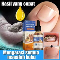 Tinh chất loại bỏ nấm móng Tinh chất bôi móng phục hồi giảm nấm 50ML