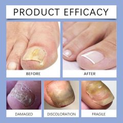 Tinh chất loại bỏ nấm móng Tinh chất bôi móng phục hồi giảm nấm 50ML